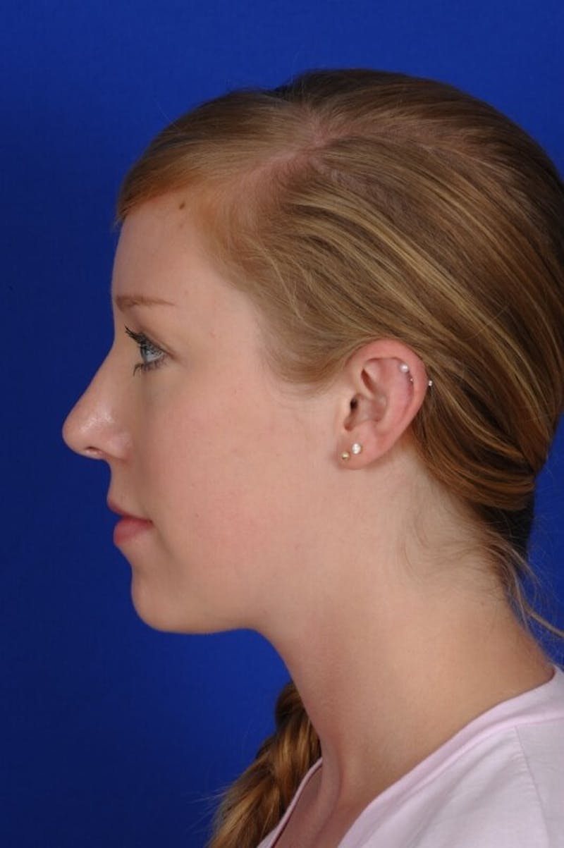 Rhinoplasty Before & After Gallery - Patient 419967 - Image 4