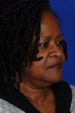 Rhinoplasty Before & After Gallery - Patient 320717 - Image 10