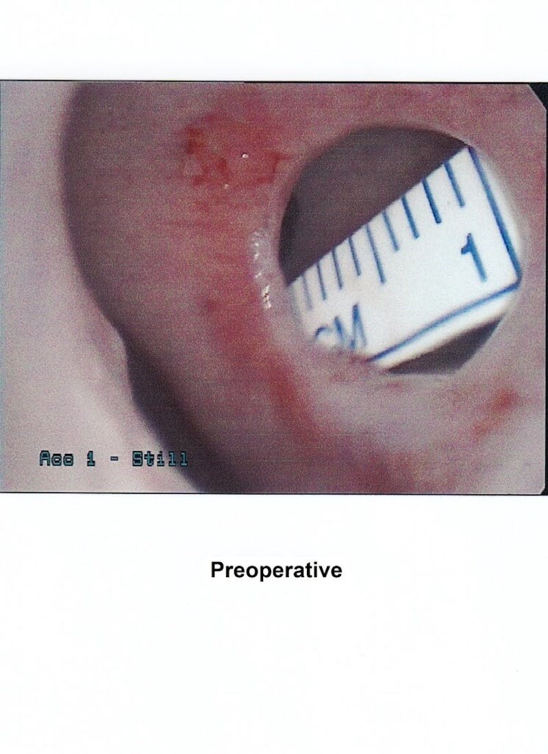 Rhinoplasty Before & After Gallery - Patient 320717 - Image 11
