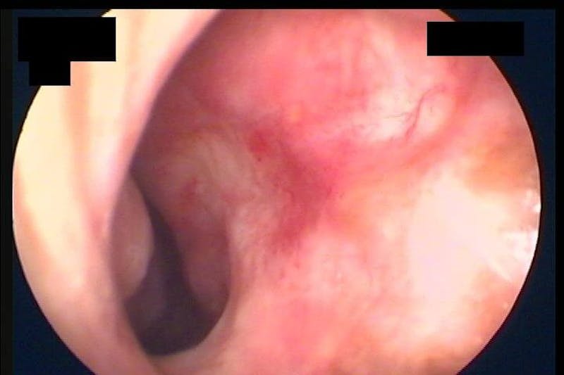Rhinoplasty Before & After Gallery - Patient 320717 - Image 12