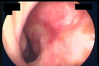 Rhinoplasty Before & After Gallery - Patient 320717 - Image 12