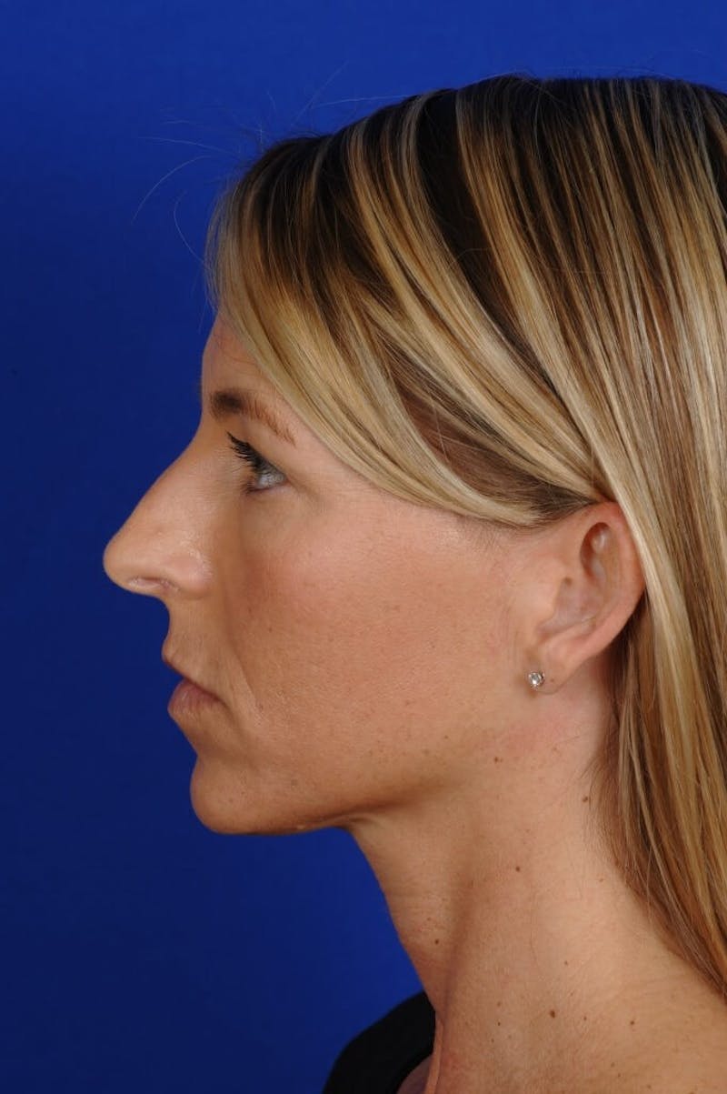 Rhinoplasty Before & After Gallery - Patient 663853 - Image 5