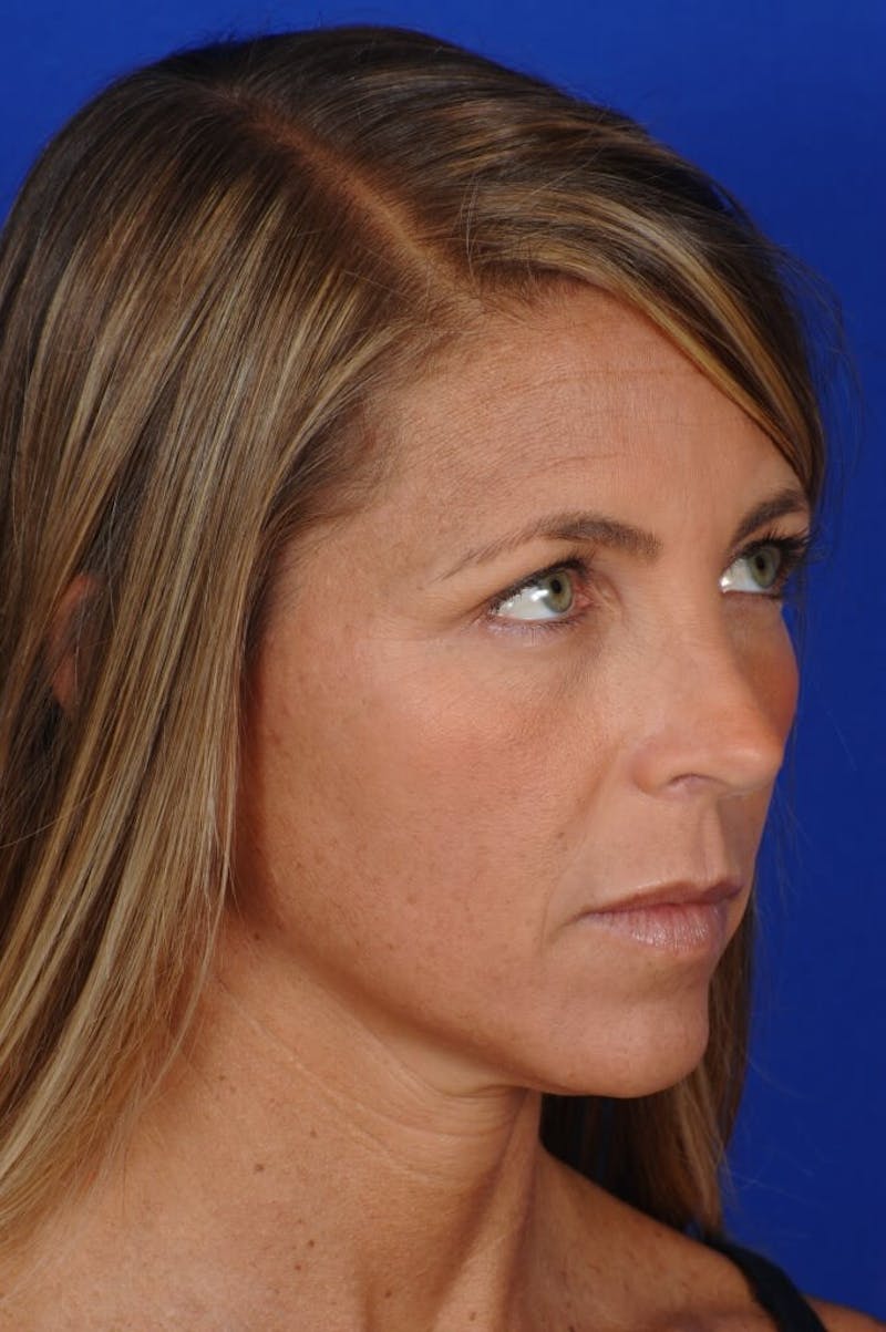 Rhinoplasty Before & After Gallery - Patient 663853 - Image 8