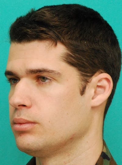 Rhinoplasty Before & After Gallery - Patient 807057 - Image 1
