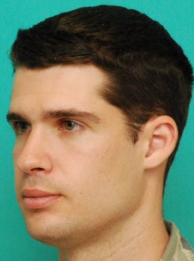 Rhinoplasty Before & After Gallery - Patient 807057 - Image 2