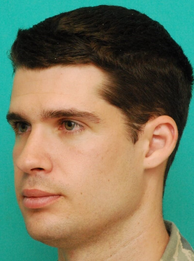 Rhinoplasty Before & After Gallery - Patient 807057 - Image 2