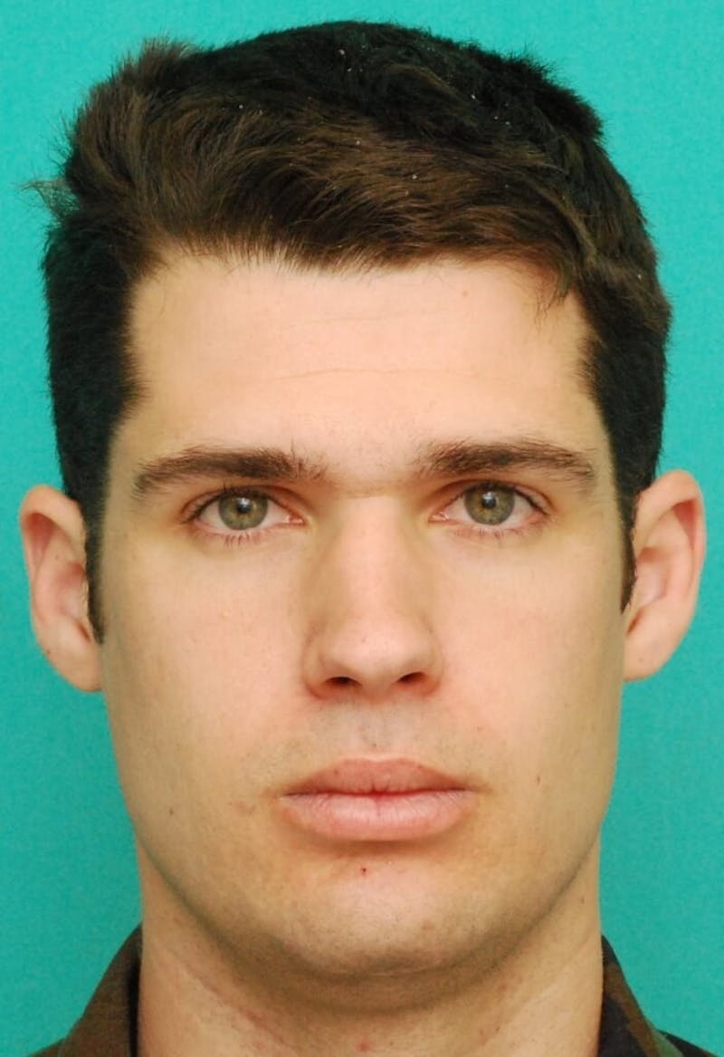 Rhinoplasty Before & After Gallery - Patient 807057 - Image 3
