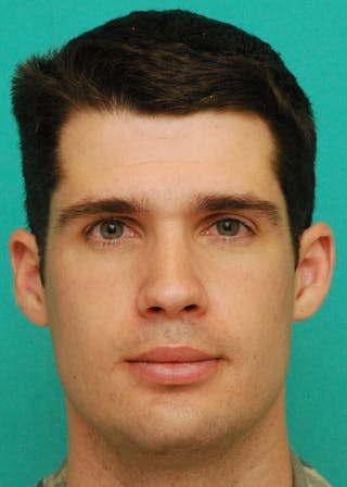 Rhinoplasty Before & After Gallery - Patient 807057 - Image 4