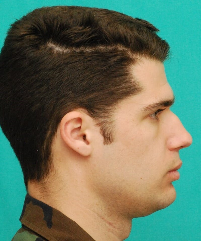 Rhinoplasty Before & After Gallery - Patient 807057 - Image 5