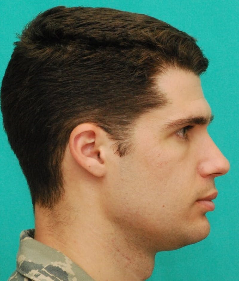 Rhinoplasty Before & After Gallery - Patient 807057 - Image 6