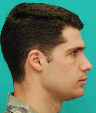 Rhinoplasty Before & After Gallery - Patient 807057 - Image 6