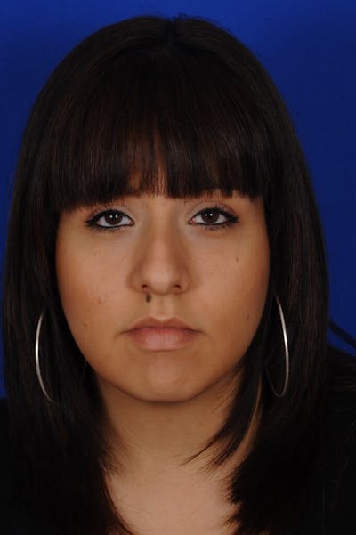 Rhinoplasty Before & After Gallery - Patient 557576 - Image 1