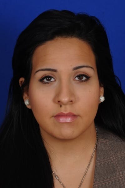 Rhinoplasty Before & After Gallery - Patient 557576 - Image 2