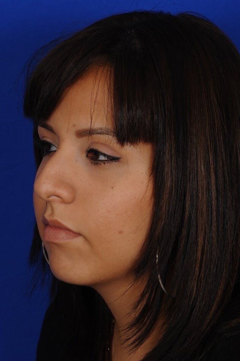 Rhinoplasty Before & After Gallery - Patient 557576 - Image 3