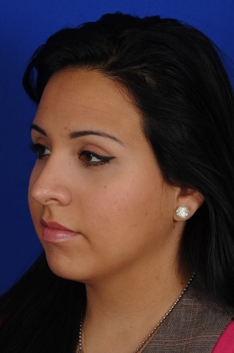 Rhinoplasty Before & After Gallery - Patient 557576 - Image 4