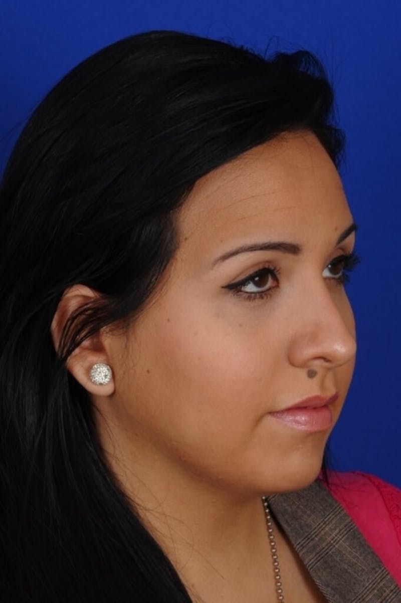 Rhinoplasty Before & After Gallery - Patient 557576 - Image 8