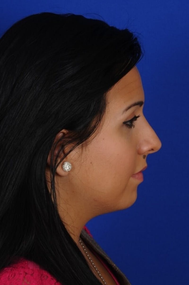 Rhinoplasty Before & After Gallery - Patient 557576 - Image 10