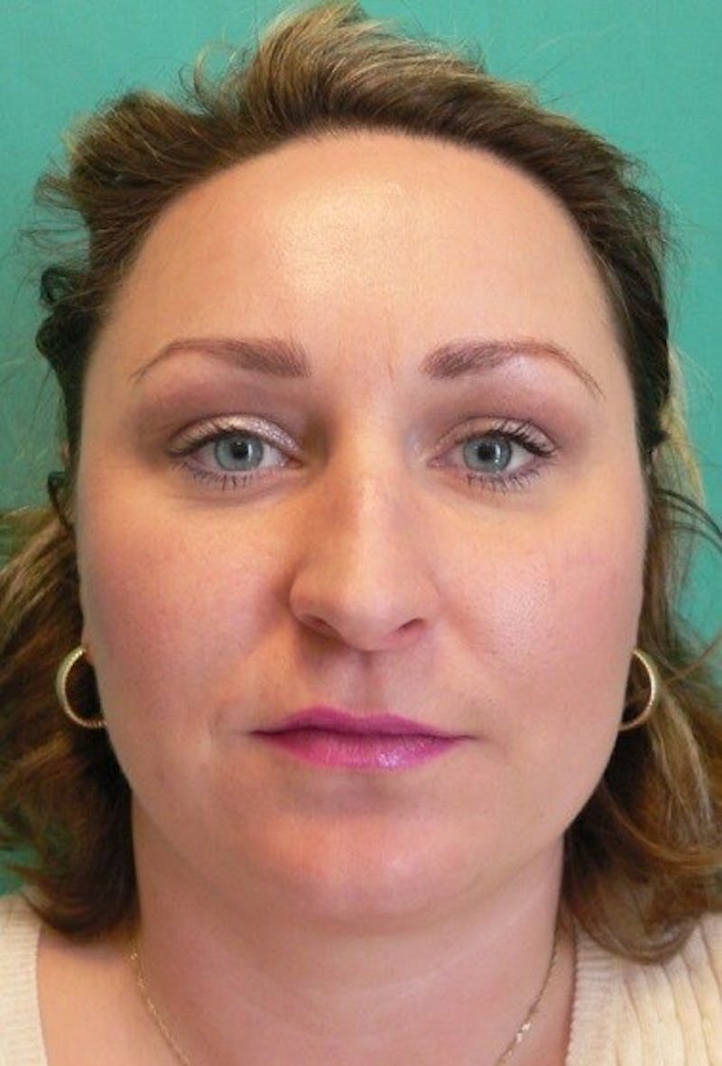 Rhinoplasty Before & After Gallery - Patient 187788 - Image 1