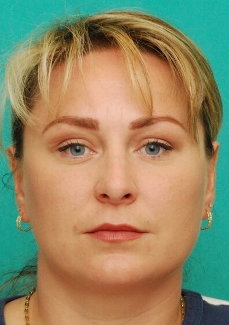 Rhinoplasty Before & After Gallery - Patient 187788 - Image 2