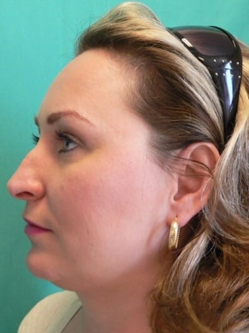 Rhinoplasty Before & After Gallery - Patient 187788 - Image 3