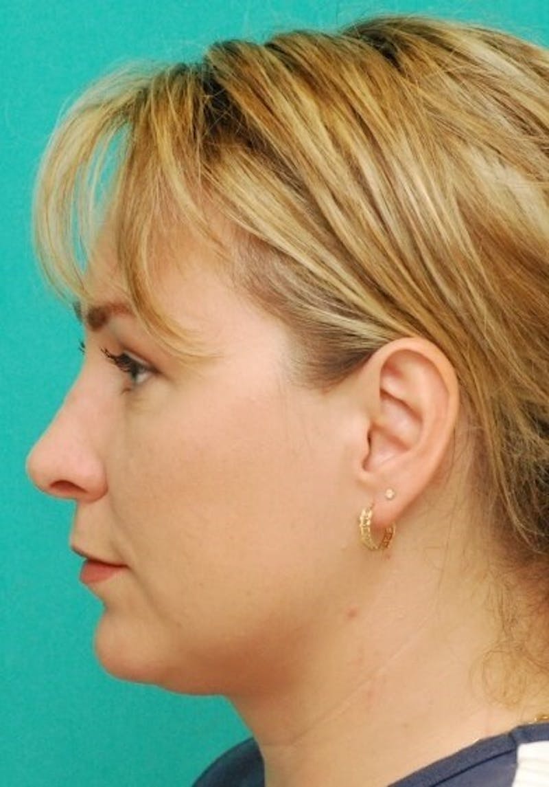 Rhinoplasty Before & After Gallery - Patient 187788 - Image 4