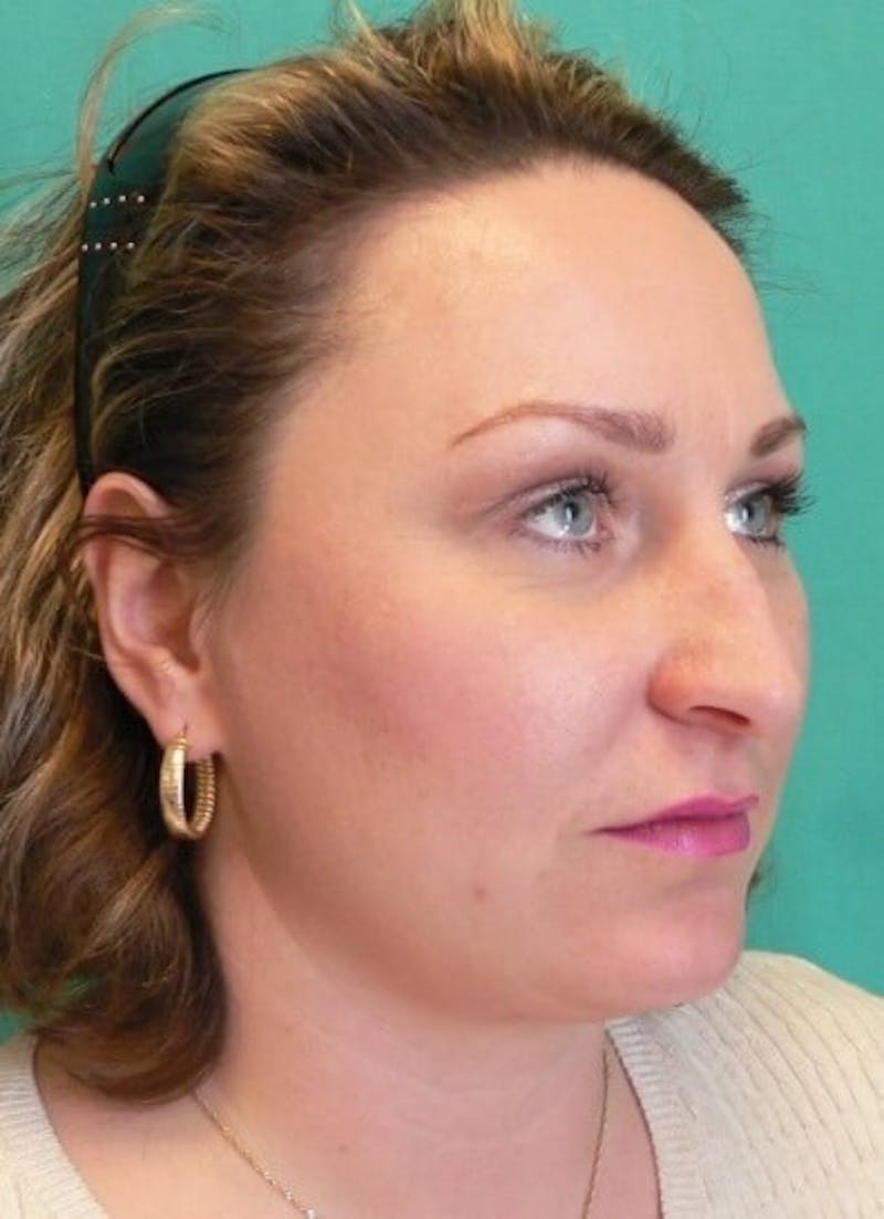 Rhinoplasty Before & After Gallery - Patient 187788 - Image 5