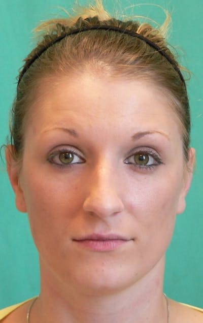Rhinoplasty Before & After Gallery - Patient 109139 - Image 1