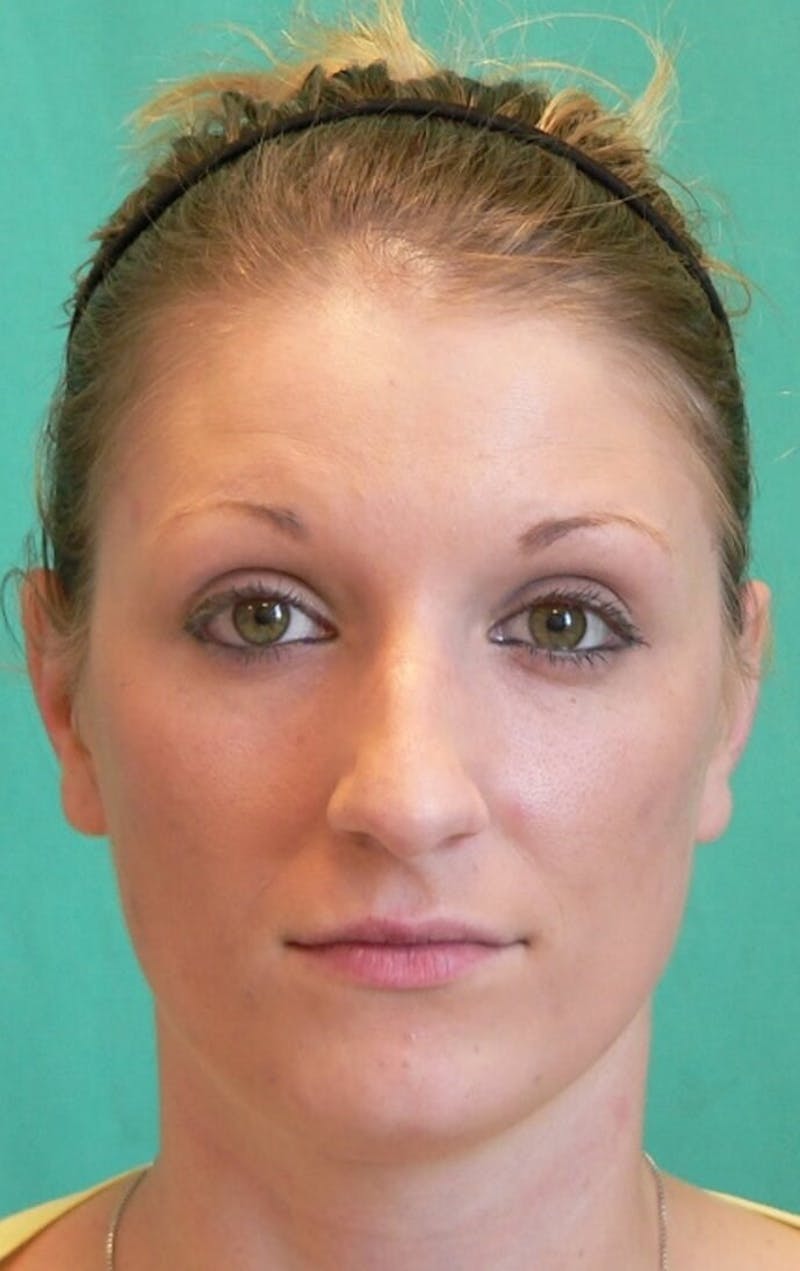 Rhinoplasty Before & After Gallery - Patient 109139 - Image 1