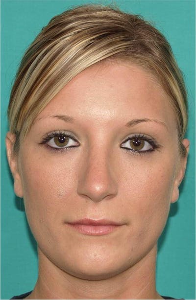 Rhinoplasty Before & After Gallery - Patient 109139 - Image 2