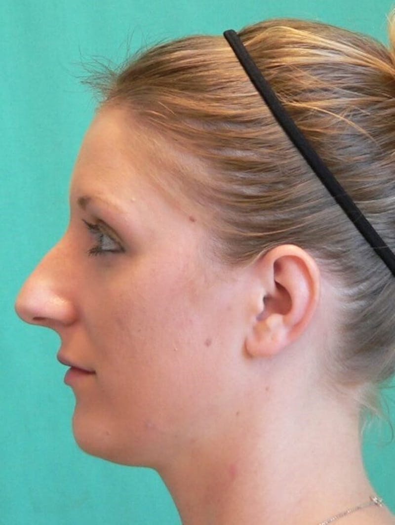 Rhinoplasty Before & After Gallery - Patient 109139 - Image 3