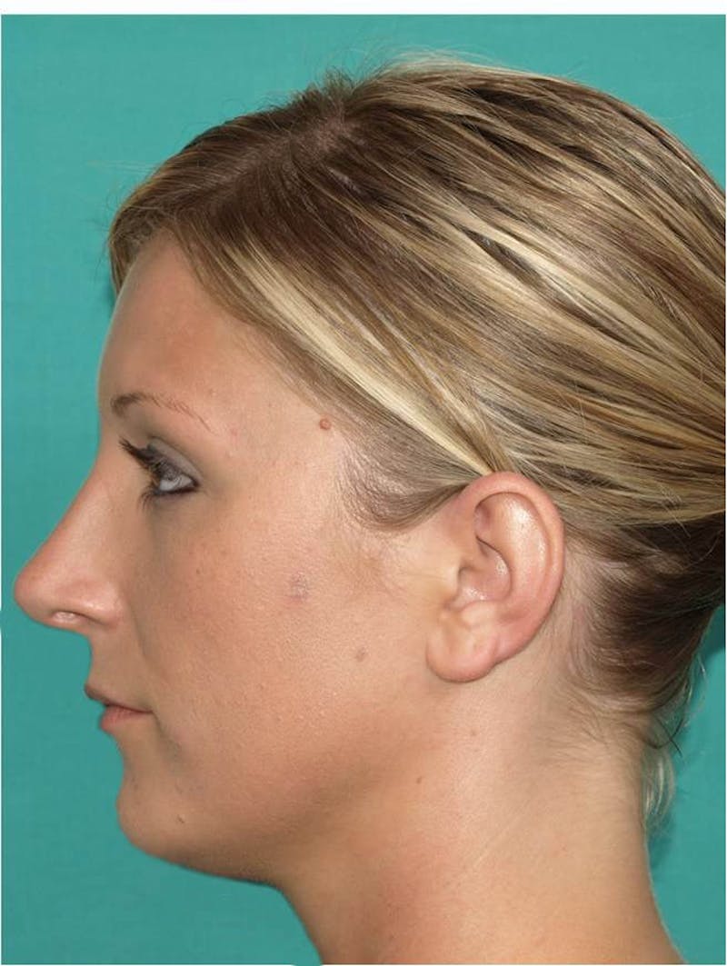 Rhinoplasty Before & After Gallery - Patient 109139 - Image 4