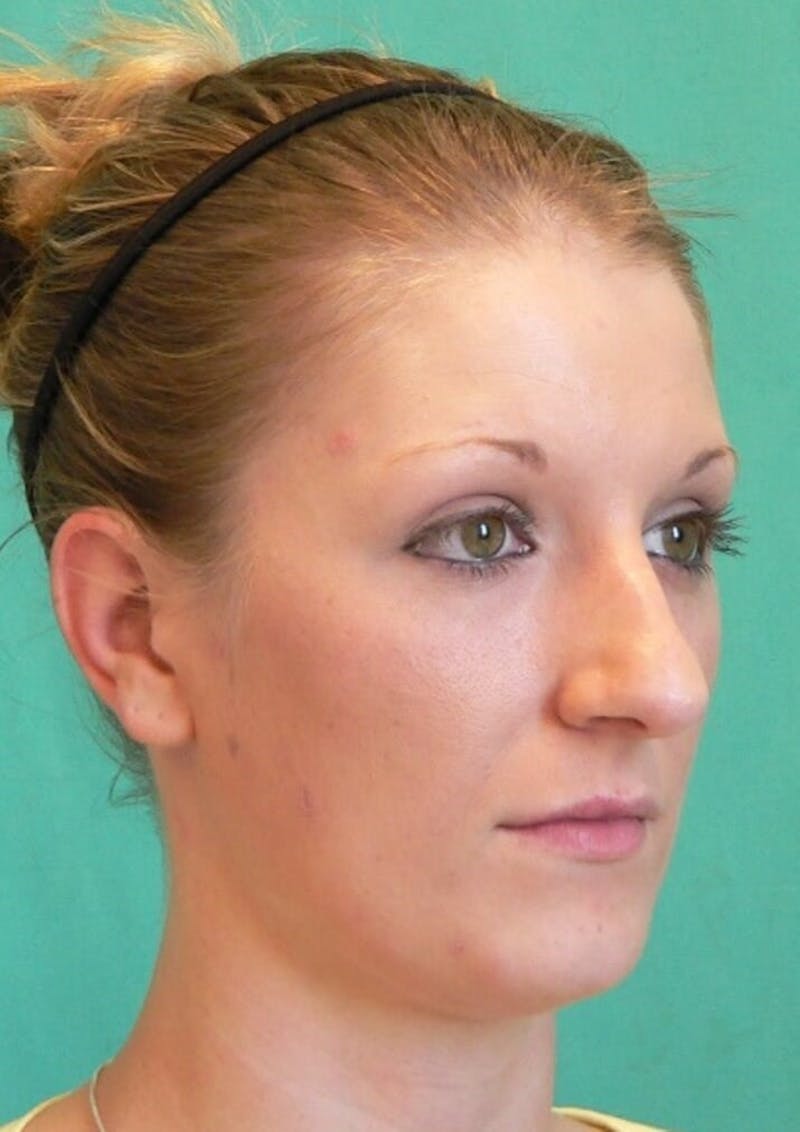 Rhinoplasty Before & After Gallery - Patient 109139 - Image 5