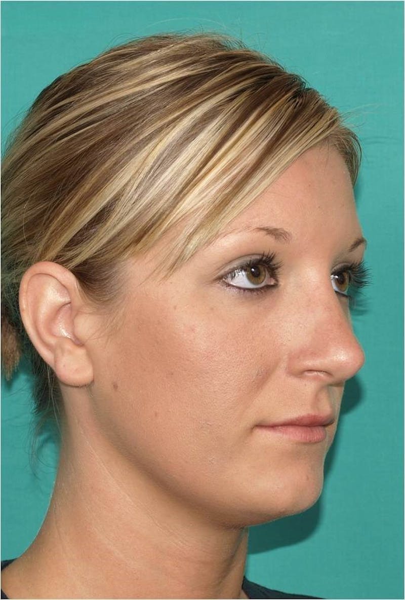 Rhinoplasty Before & After Gallery - Patient 109139 - Image 6