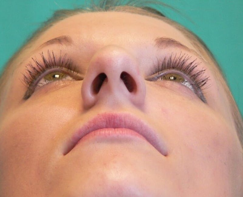 Rhinoplasty Before & After Gallery - Patient 109139 - Image 7