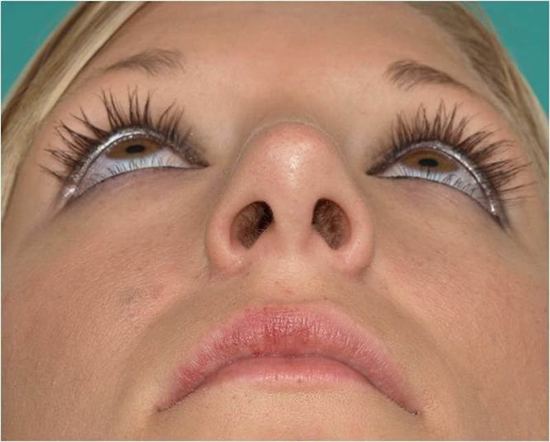 Rhinoplasty Before & After Gallery - Patient 109139 - Image 8