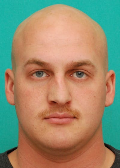 Rhinoplasty Before & After Gallery - Patient 378594 - Image 1