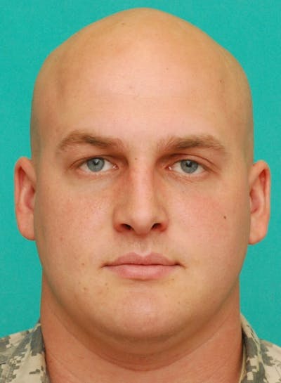 Rhinoplasty Before & After Gallery - Patient 378594 - Image 2