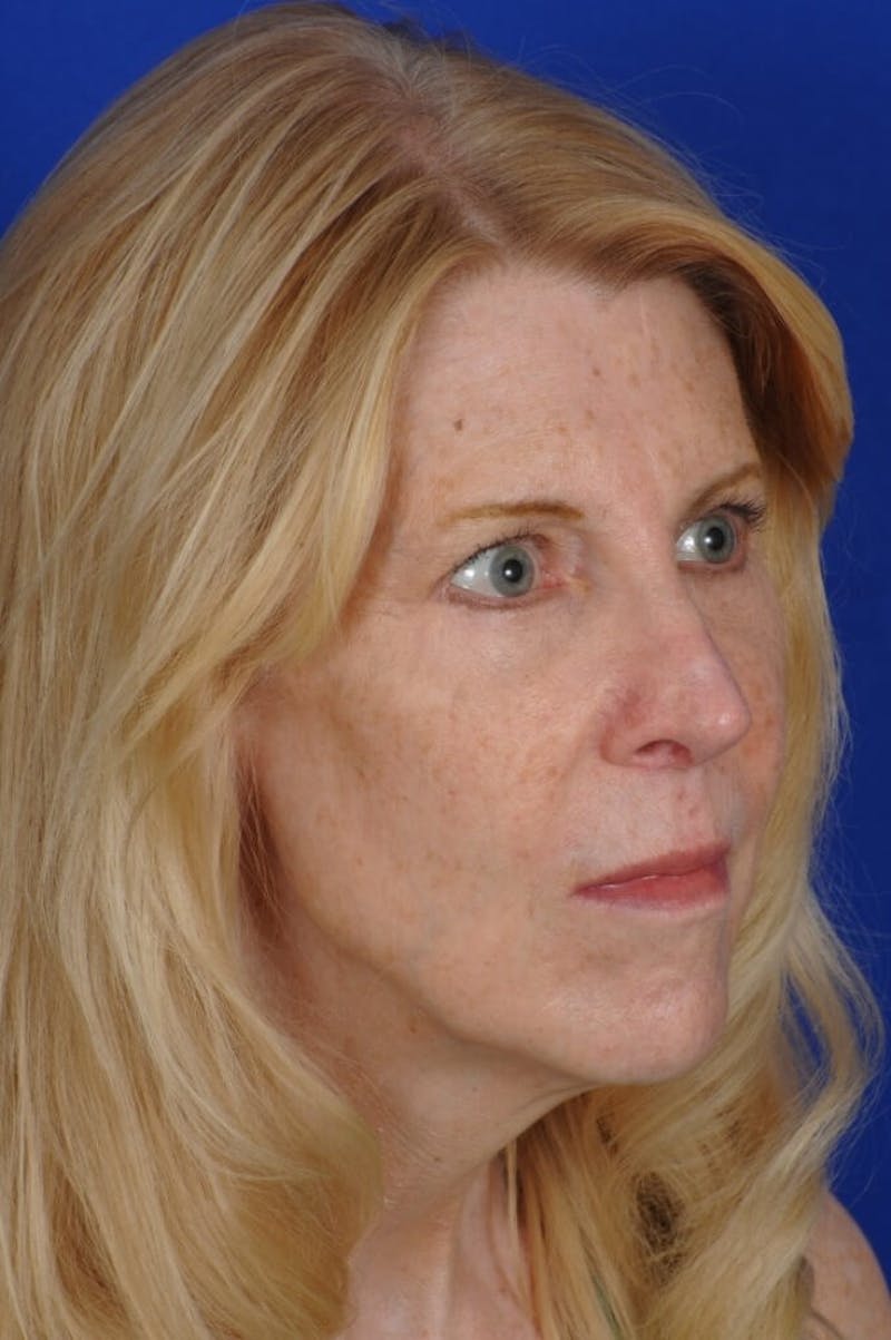 Rhinoplasty Before & After Gallery - Patient 393833 - Image 6