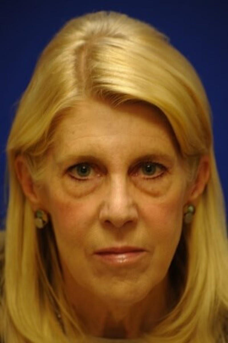 Rhinoplasty Before & After Gallery - Patient 393833 - Image 9