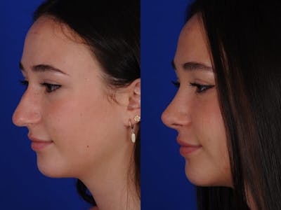 Rhinoplasty Before & After Gallery - Patient 336339 - Image 1