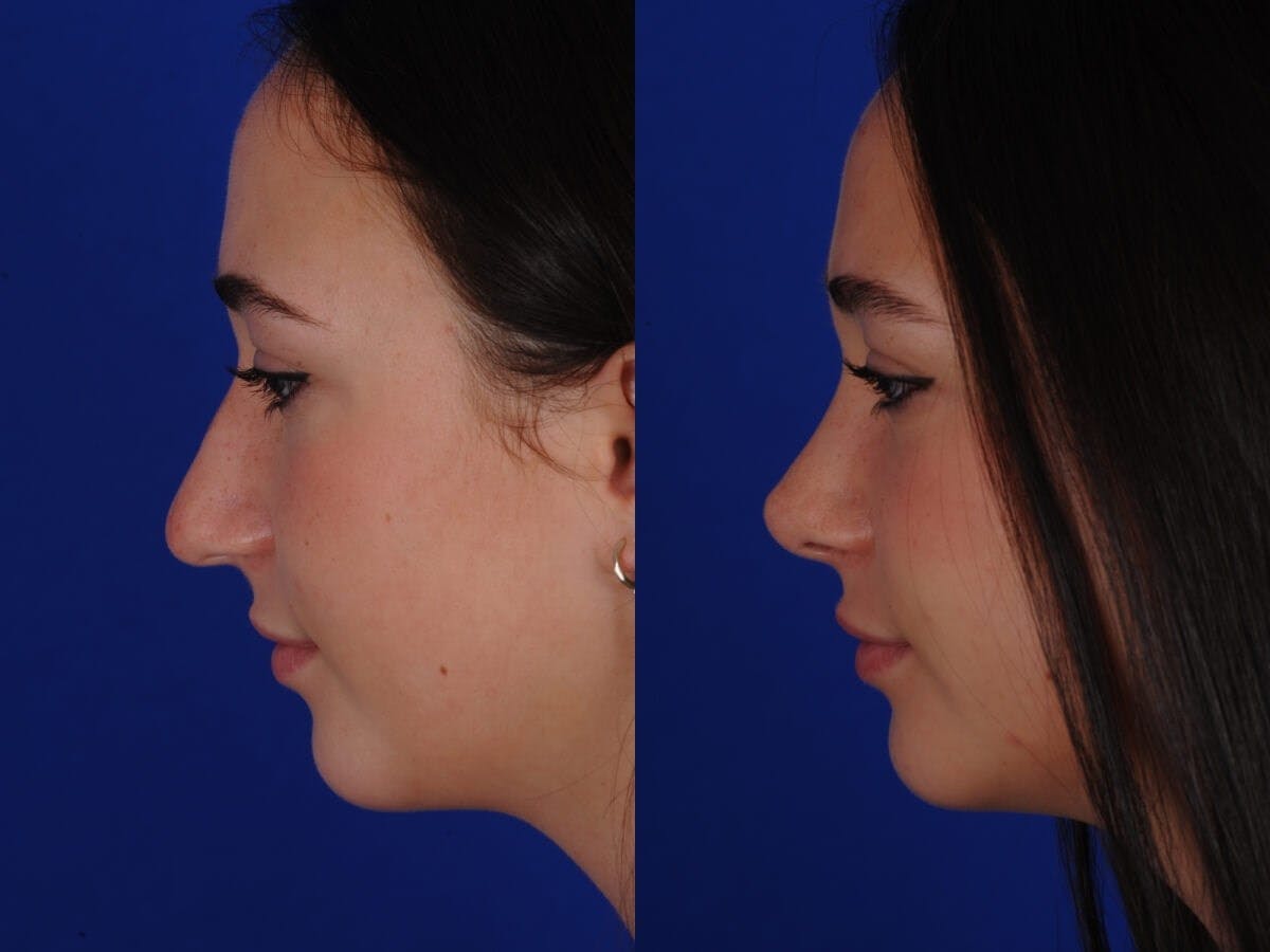 Rhinoplasty Before & After Gallery - Patient 336339 - Image 2