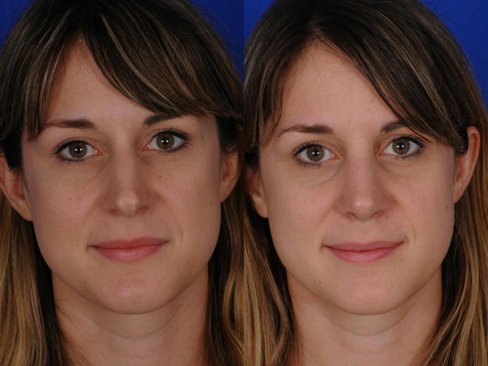 Rhinoplasty Before & After Gallery - Patient 200812 - Image 1