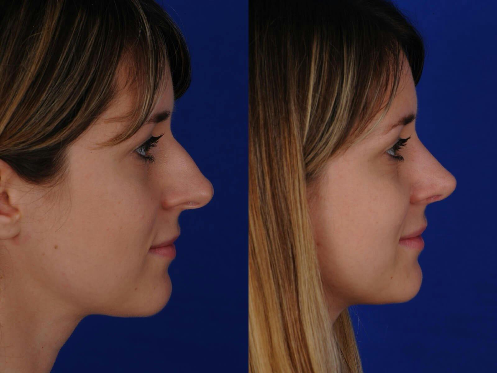 Rhinoplasty Before & After Gallery - Patient 200812 - Image 2