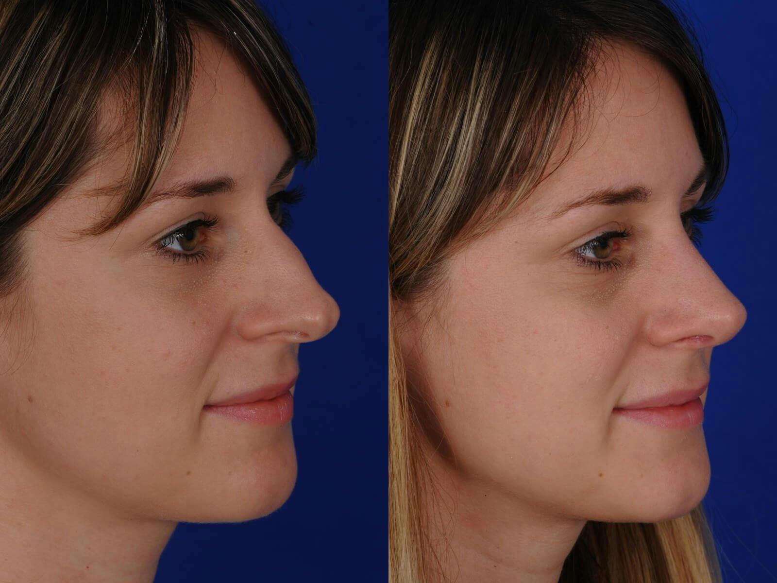Rhinoplasty Before & After Gallery - Patient 200812 - Image 3
