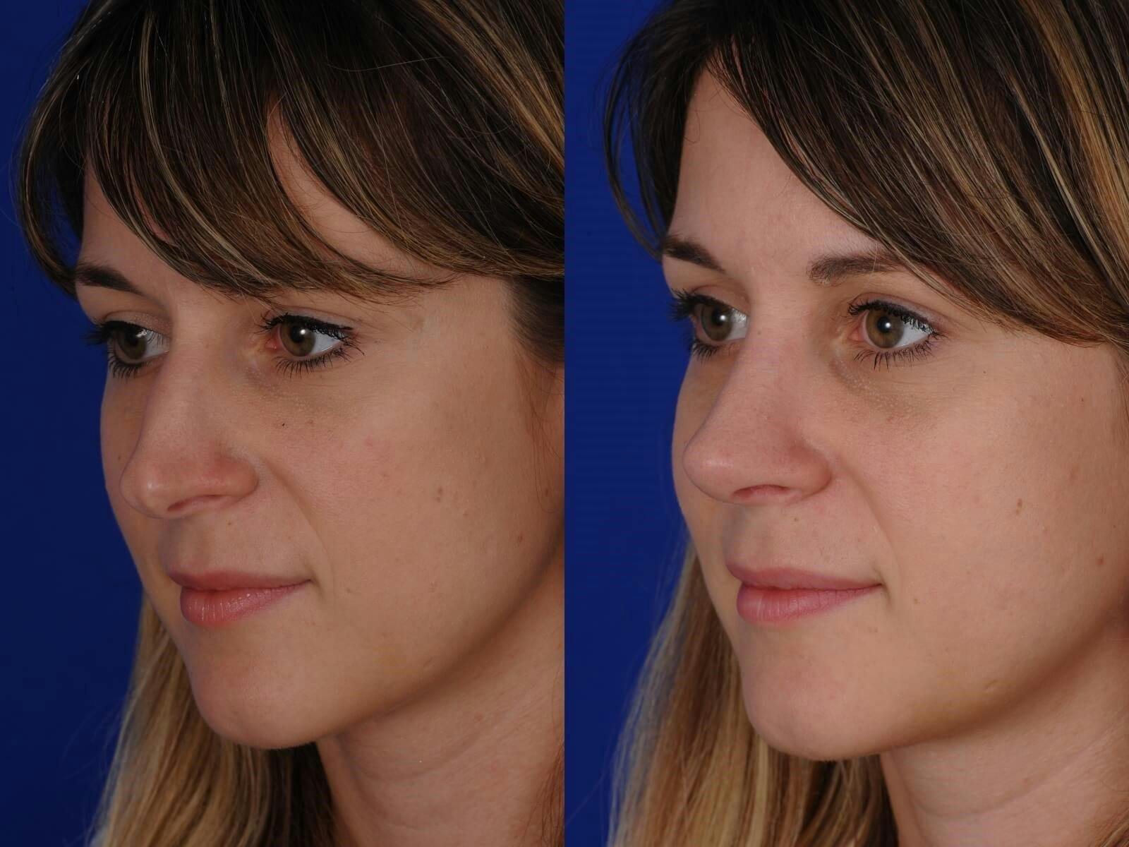 Rhinoplasty Before & After Gallery - Patient 200812 - Image 4
