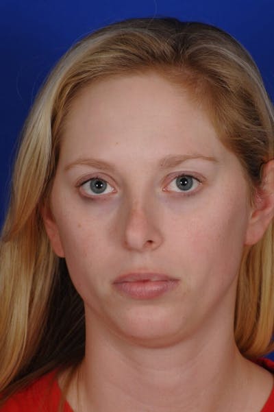 Septoplasty Before & After Gallery - Patient 484034 - Image 1