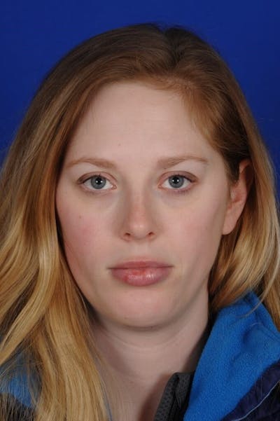 Septoplasty Before & After Gallery - Patient 484034 - Image 2