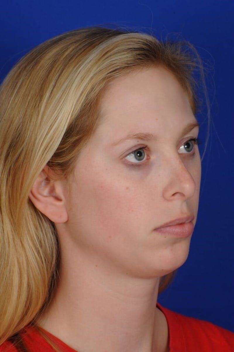 Septoplasty Before & After Gallery - Patient 484034 - Image 5