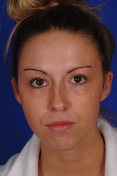 Septoplasty Before & After Gallery - Patient 316791 - Image 1