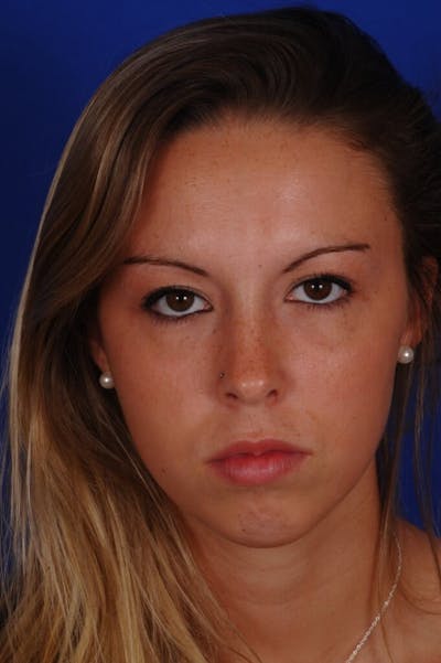 Septoplasty Before & After Gallery - Patient 316791 - Image 2